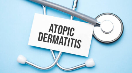Atopic dermatitis – Symptoms, triggers, and management