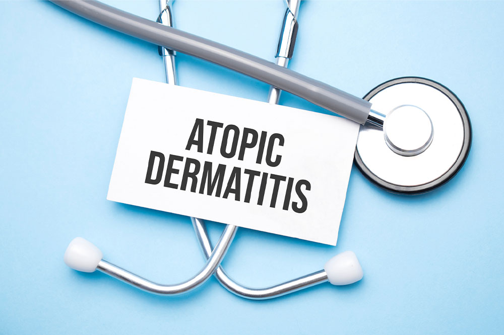 Atopic dermatitis – Symptoms, triggers, and management