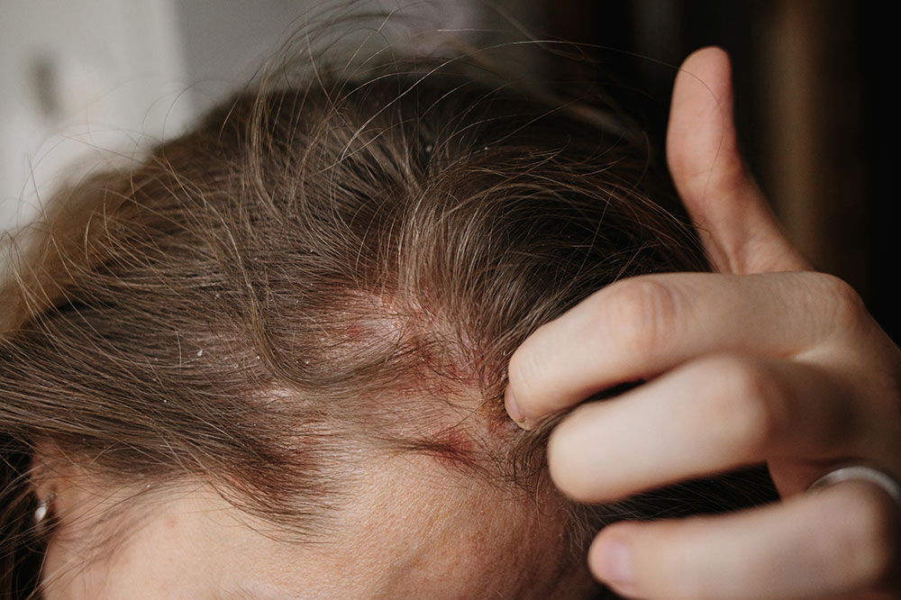 Scalp psoriasis – Symptoms, causes, and more