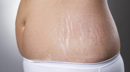 Managing stretch marks – Causes, remedies, and more