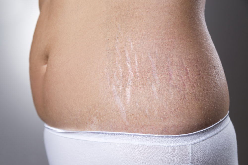 Managing stretch marks – Causes, remedies, and more