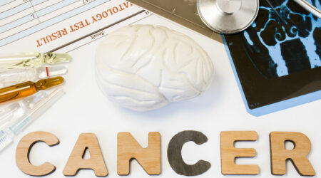 Brain cancer – Causes, symptoms, and management