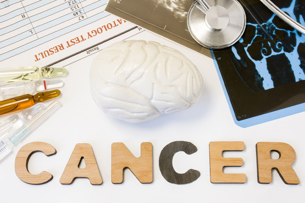 Brain cancer – Causes, symptoms, and management