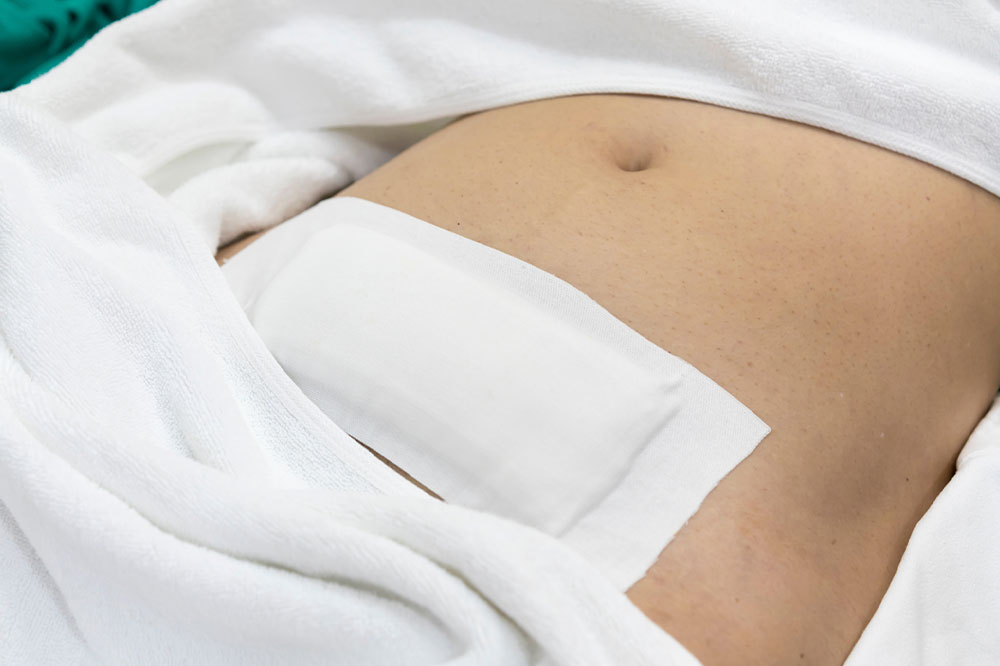 Myomectomy – Types, symptoms, and management