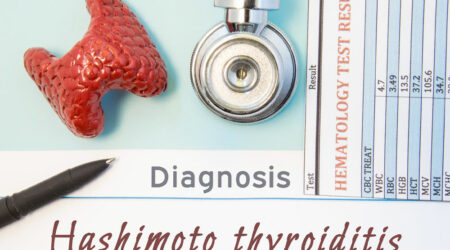 Hashimoto’s thyroiditis – Symptoms, causes, and management