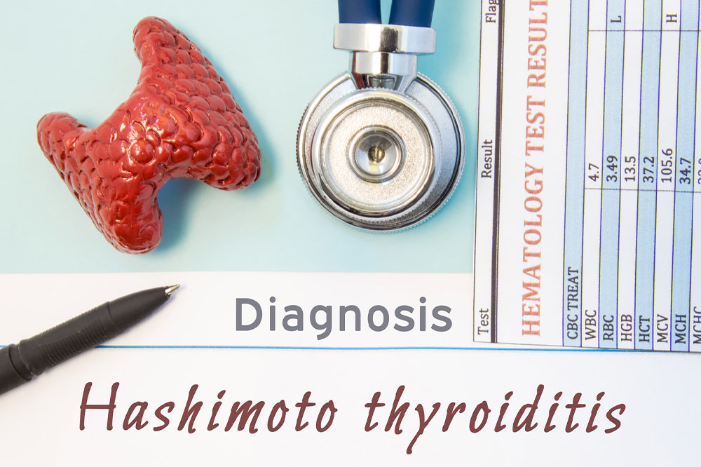 Hashimoto’s thyroiditis – Symptoms, causes, and management
