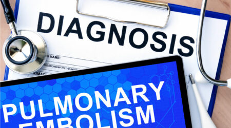 Pulmonary embolism – Causes, symptoms, and management options