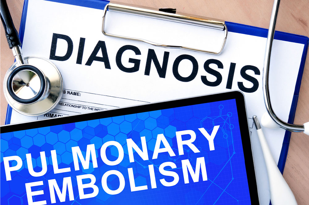 Pulmonary embolism – Causes, symptoms, and management options